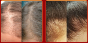 lizz ante sos crescimento antes e depois